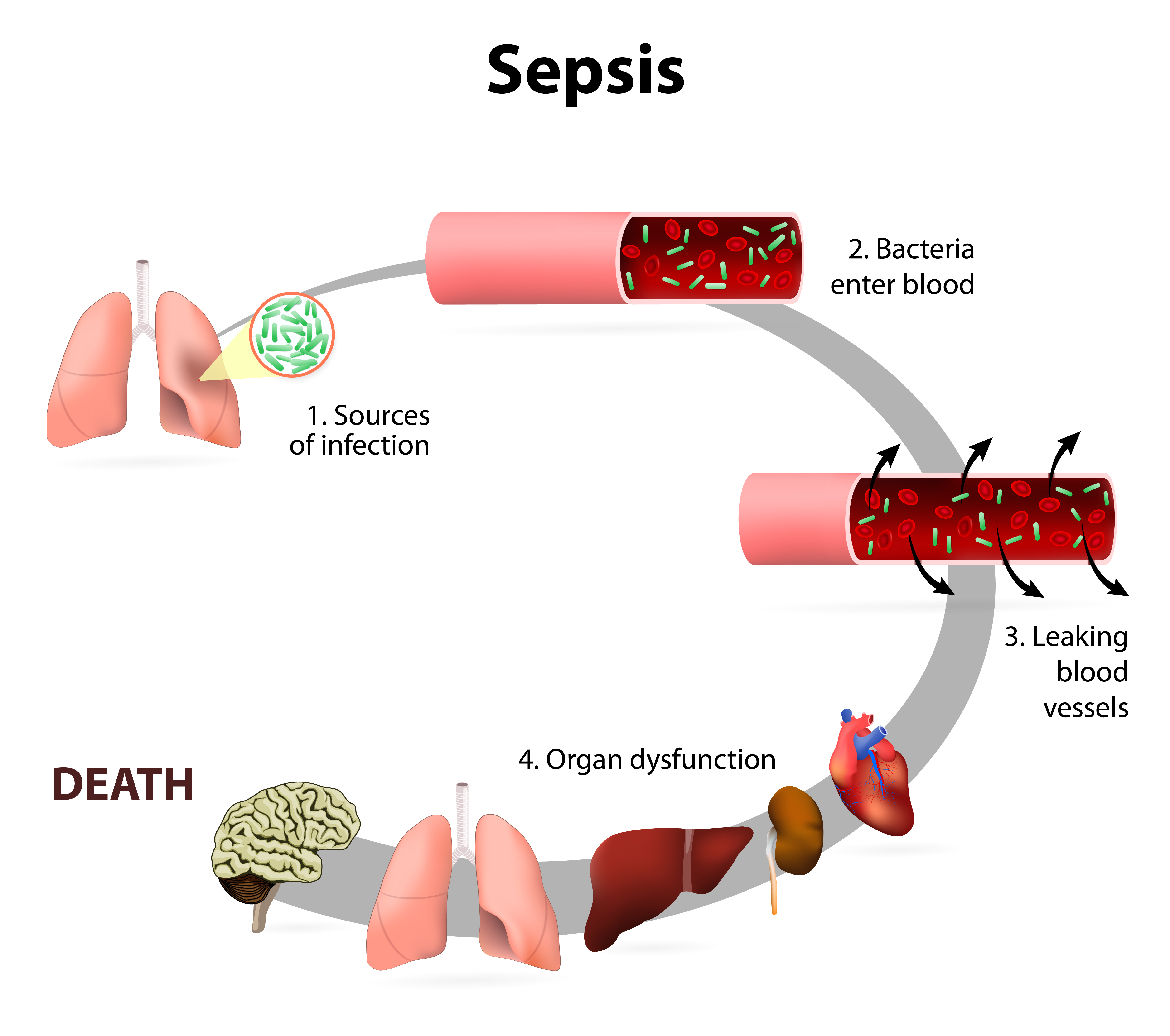 Can A Blood Infection Lead To Sepsis