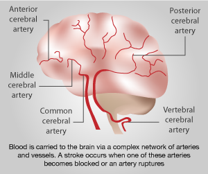 National Stroke Awareness Month