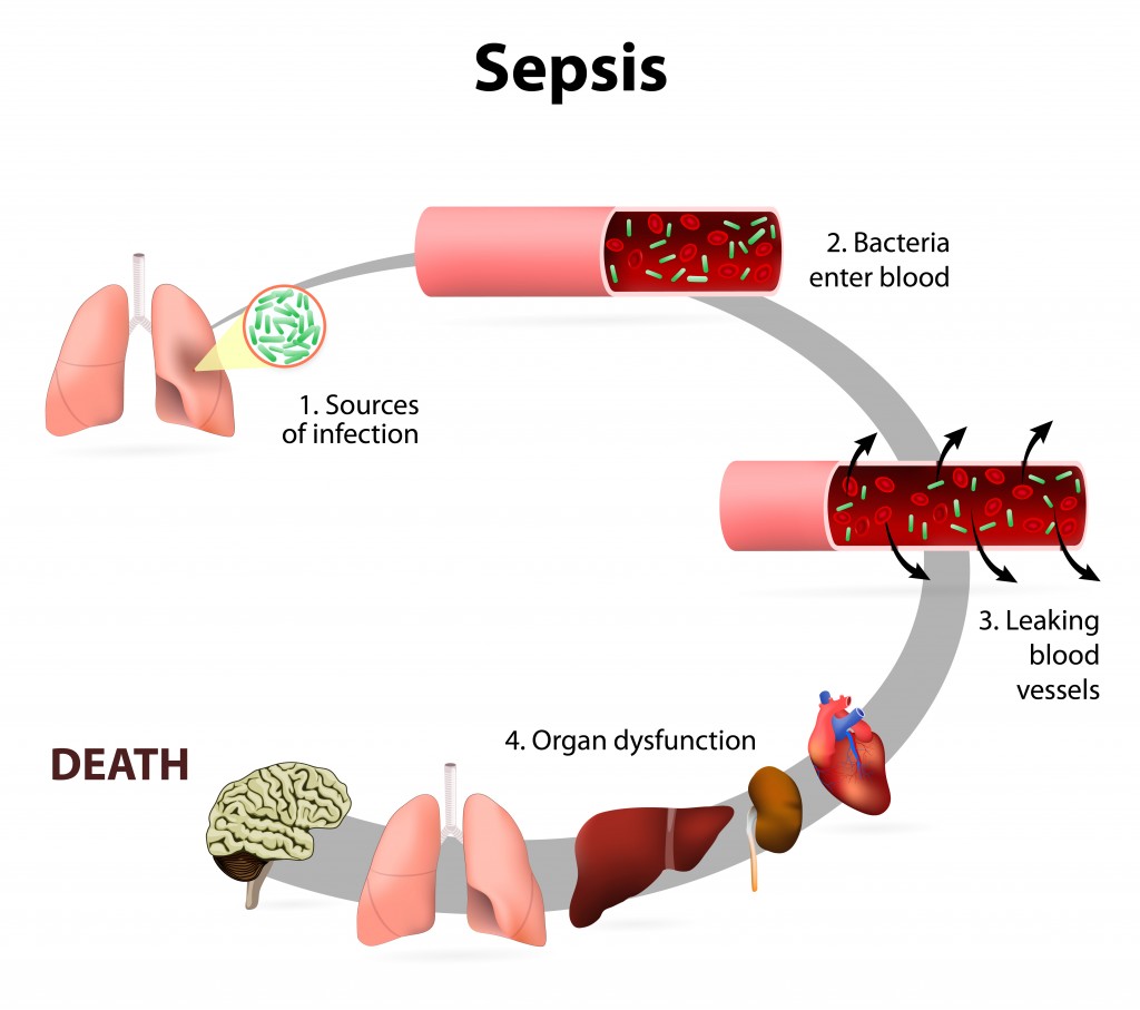 “Blood Poisoning” – New Research Sheds Light On Ancient Disease