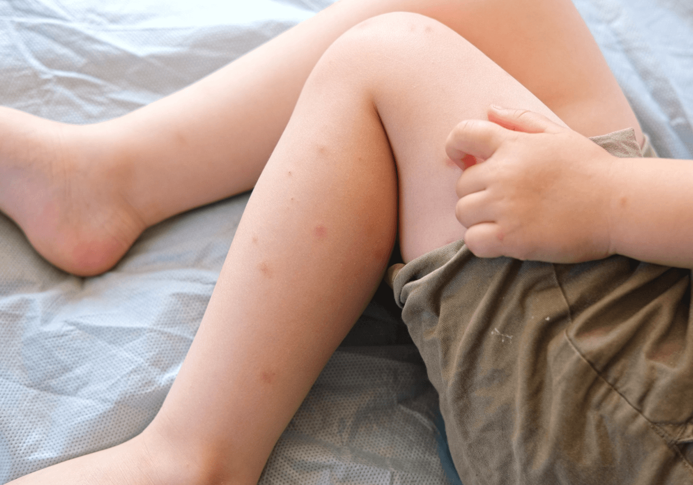 Measles